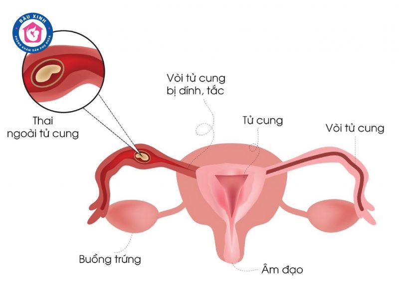 Thai ngoài tử cung được xem là một tình trạng hiếm gặp nhưng vô cùng nguy hiểm đối với sức khỏe của mọi thai phụ